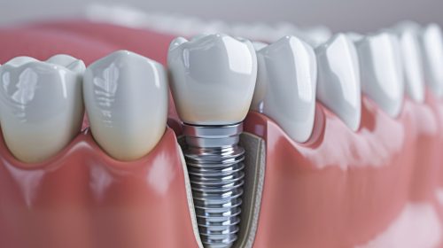3d illustration of a titanium dental implant in the lower jaw