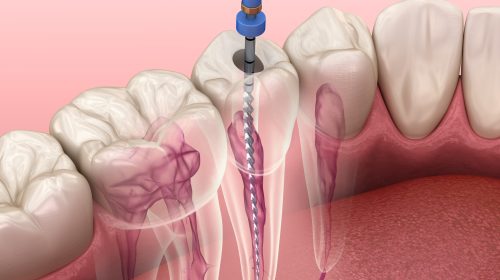Endodontic root canal treatment process. Medically accurate tooth 3D illustration.