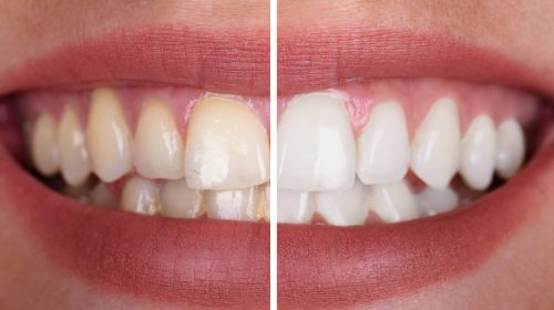 Close-up Of A Smiling Woman's Teeth Before And After Whitening
